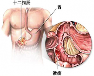 什么病因引起的_十二指肠溃疡_鄂州爱民中西医结合胃肠医院